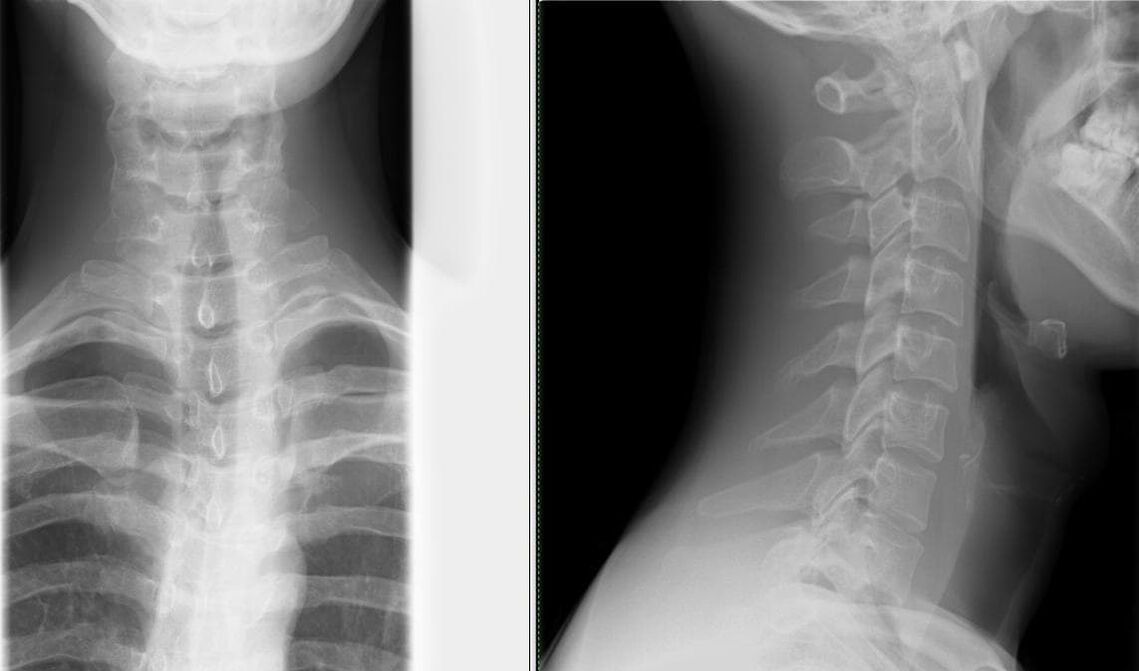 Омуртканын рентгенографиясы остеохондрозду аныктоонун жөнөкөй жана эффективдүү ыкмасы болуп саналат